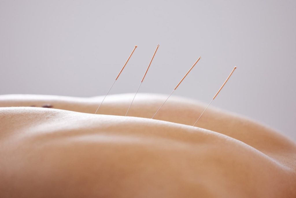 Comment l'acupuncture peut vous aider à atteindre vos objectifs de perte de poids ?