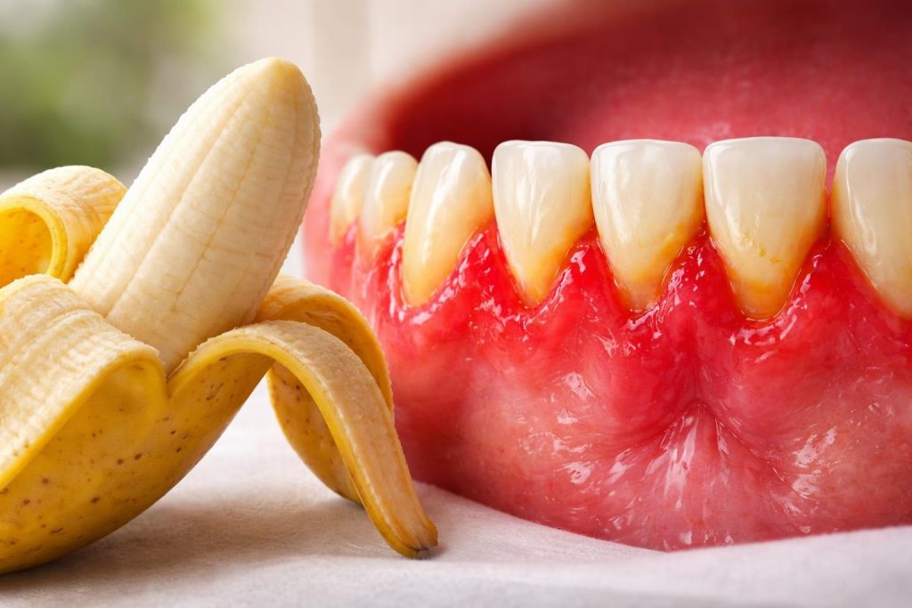 découvrez comment la consommation de banane peut influencer la santé de vos gencives et les précautions à prendre pour prévenir la gingivite.